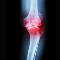 Dolor crónico de rodilla