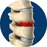 roce de vertebras